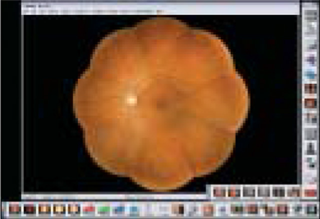 9 Points Internal Fixation