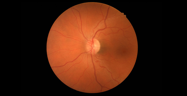Nonmyd 8 Retinal Camera Features
